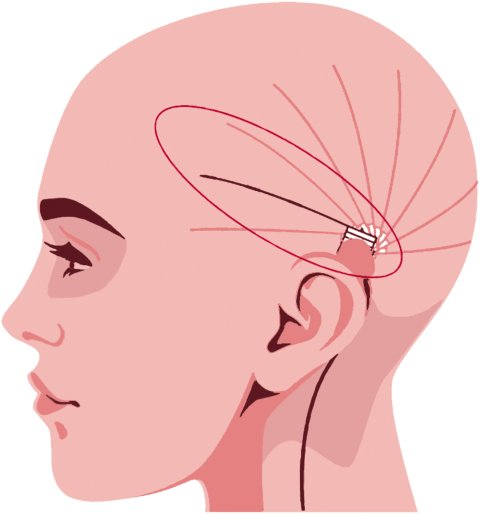 Schematic depiction of a head in profile, with lines and ellipses showing possible positions for an implant for epilepsy monitoring