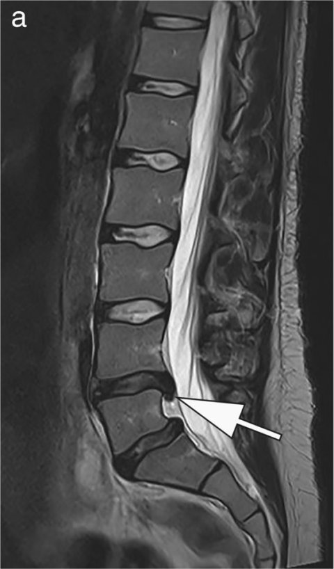 MRI image of a spine