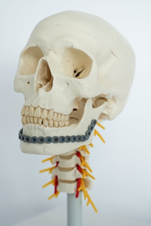 Ein menschlicher Schädel mit einem Titan-Implantat am Unterkiefer