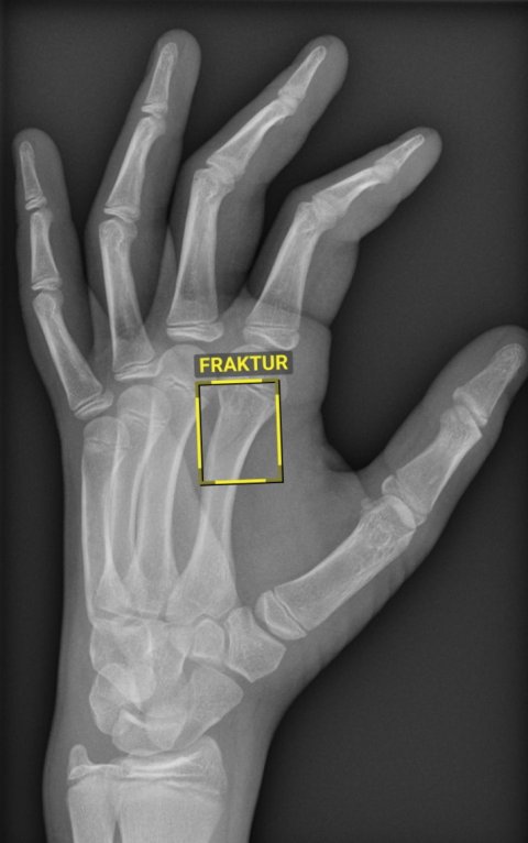 Röntgenbild einer linken Hand. Im unteren Bereich des Zeigefingers ist eine rechteckige gelbe Markierung mti der Überschrift FRAKTUR