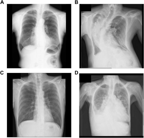 Four x-ray thorax images arranged in a 2x2 grid