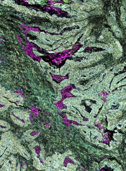 Zellstrukturen bei Darmkrebs in unterschiedlichen Grüntönen. Neutrophile werden als lila- bis pinkfarbene Flecken angezeigt