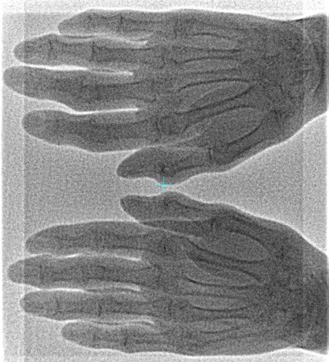 X-ray medical imaging of a person's hands