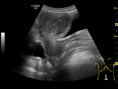 Ultrasound image of fluid in the Douglas space after trauma