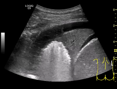 Ultrasound image of a lung contusion after trauma