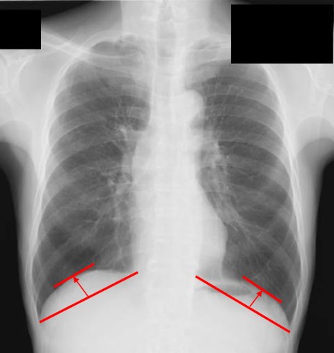 Medical X-ray scan of a thorax with lungs