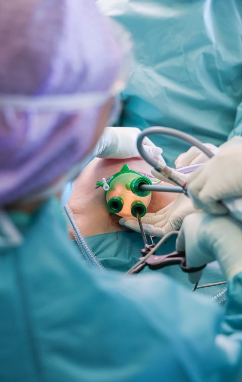 Detailaufnahme einer Single-Port-Mastektomie; die Kamera blickt über die Schulter der Chirurgin auf die Brust der Patientin, in die von der Seite über eine Führungsschiene das Endoskop und Instrumente eingeführt wurden