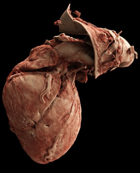 Rendering of a heart with Tetralogy of Fallot, showing external vasculature and muscle fibers