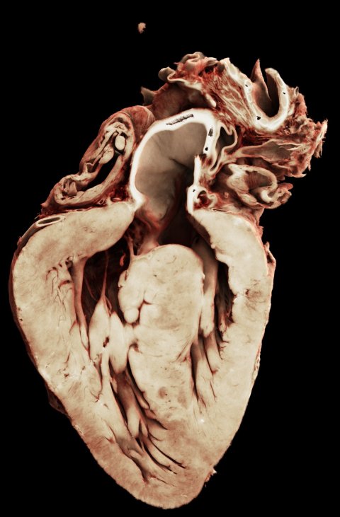 Rendering of a heart with Tetralogy of Fallot showing the septal defect