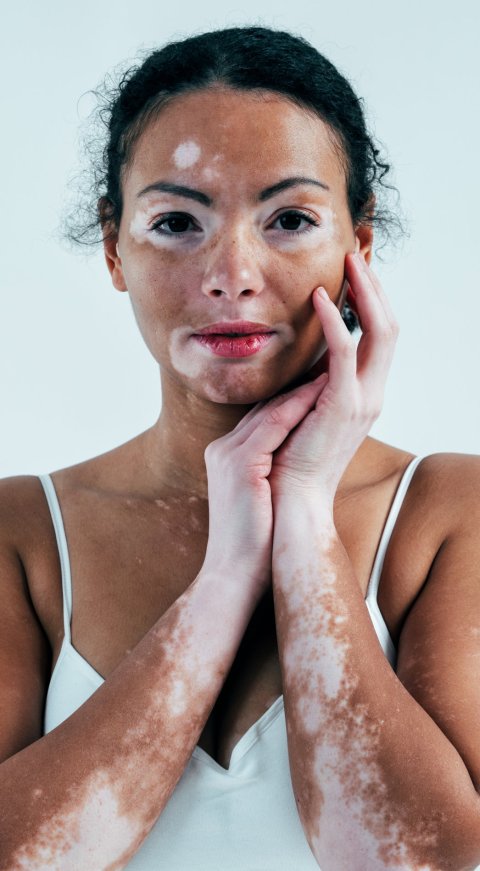A woman with characteristic white skin patches from vitligo