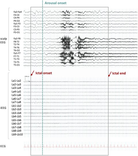 Zwei EEG-Kurven nächtlicher Gehirnaktivität, mit hohen Ausschlägen oben und geringen Ausschlägen unten