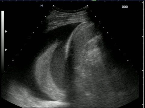 Extended focussed assessment by sonography in trauma (eFAST) scan