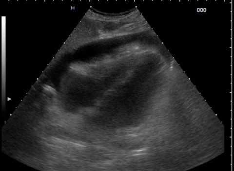 eFAST: extended Focused Assessment with Sonography in Trauma 