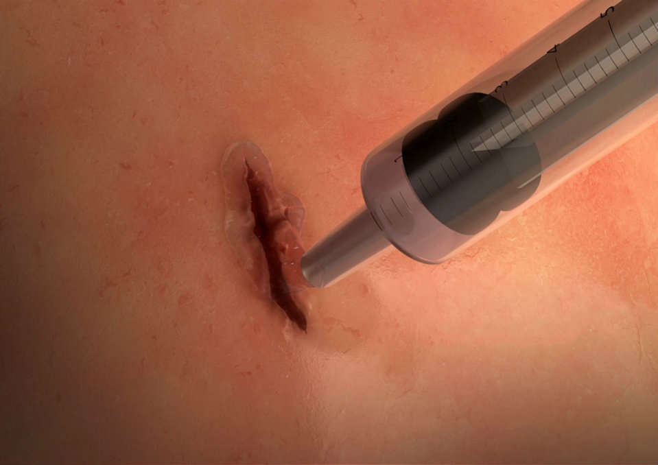 Incision after closure of the wound and application of surgical glue