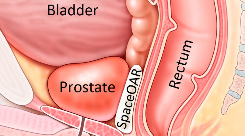 what cause prostate cancer treatment)