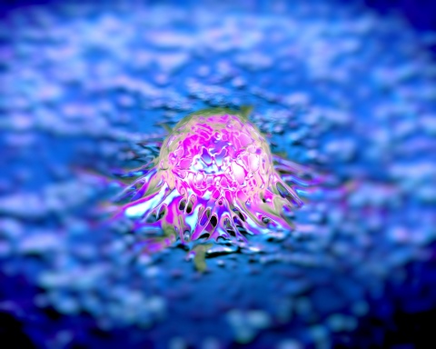 Prostate cancer cells, SEM