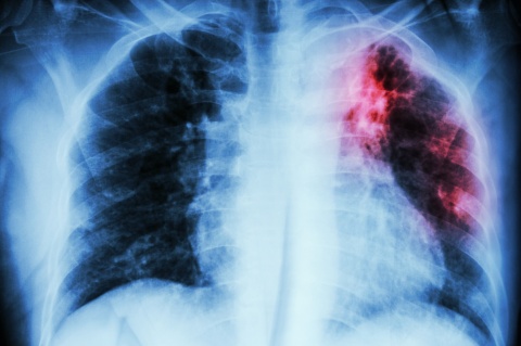 Pulmonary Tuberculosis . Chest X-ray : interstitial infiltration at left upper lung due to Mycobacterium Tuberculosis infection