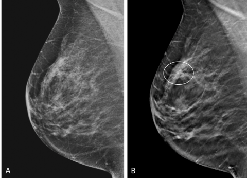 Normal breast - composition B, Radiology Case