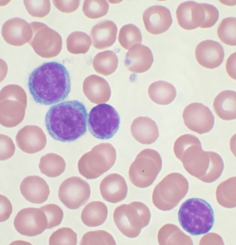 Chronic lymphocytic leukemia
