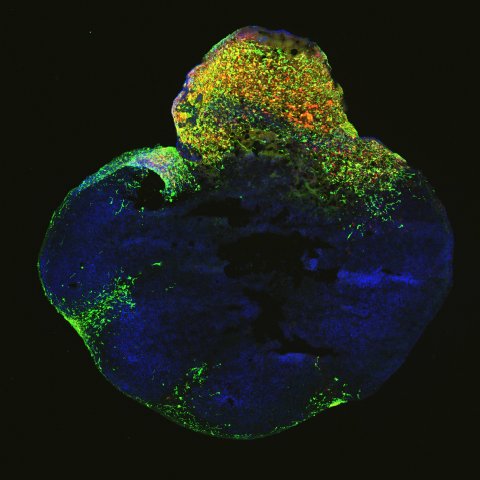 organoid with glioblastoma brain tumor