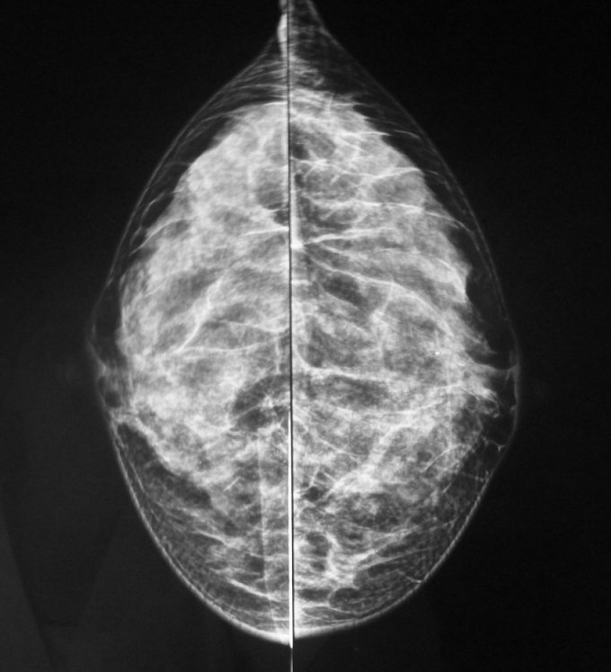 Mammography - Wikipedia