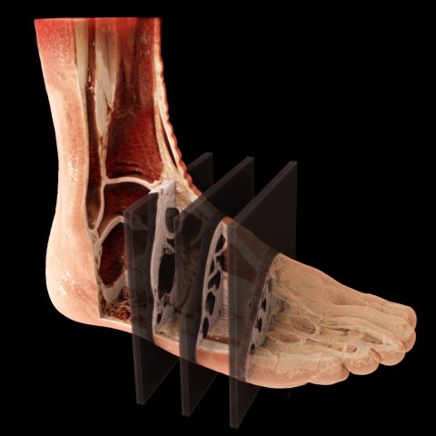 MRI scan of foot with simultaneous multi slice technology