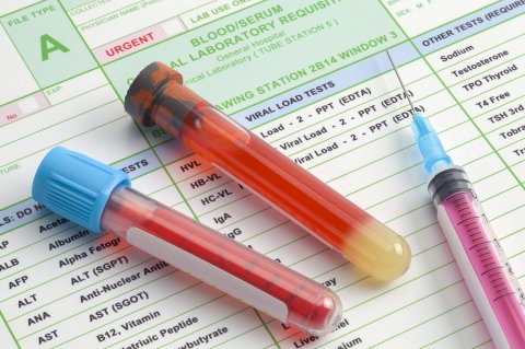 Blood Vials and Syringe with Needle on Top of Lab Results.