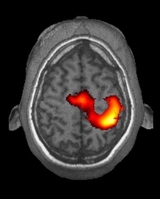 fMRI imaging of activated motorcortex in a human brain